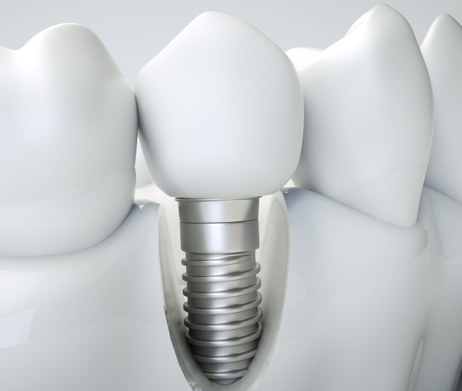 Dental Implants Green Brook Dunellen NJ